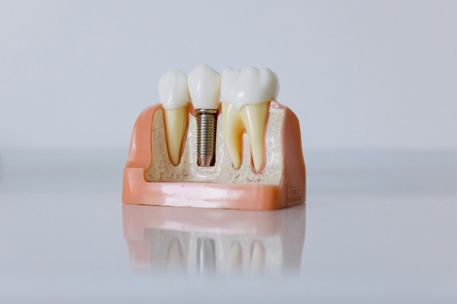 Home Detailed dental implant model showcasing teeth structure for educational purposes.